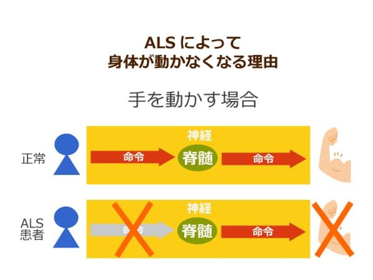 ALSによって身体が動かなくなる理由