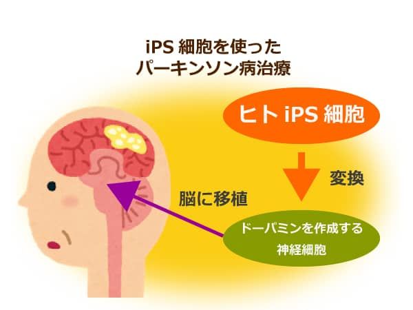iPS細胞を使ったパーキンソン病治療