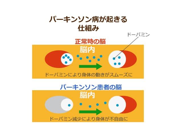 パーキンソン病が起きる仕組み