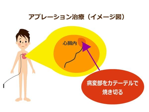 アブレーション治療のイメージ図