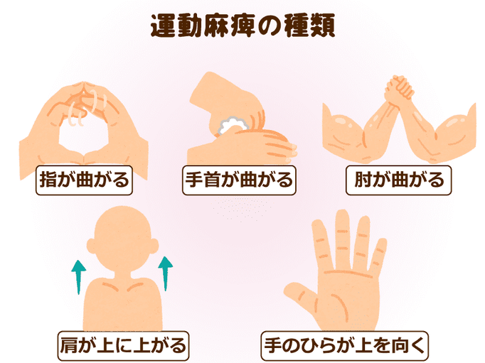 脳梗塞の症状と対策を解説 運動麻痺 で動かなくなった手が時間をかけたリハビリで動くように 家でもできる簡単ストレッチ 動画付き 介護の教科書 みんなの介護