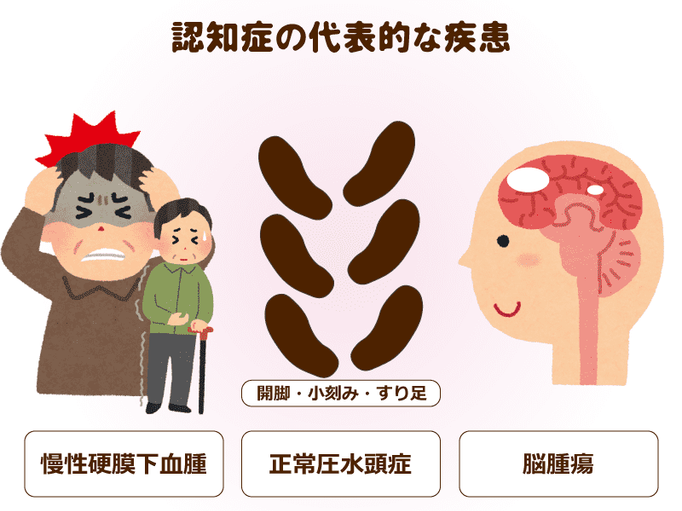 認知症はどんな病気 生活する上で記憶力が身につかない 物事の流れなどの判断力が低下する 認知症とは 覚えられられない病気 介護の教科書 みんなの介護