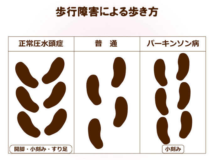 認知症はどんな病気 生活する上で記憶力が身につかない 物事の流れなどの判断力が低下する 認知症とは 覚えられられない病気 介護の教科書 みんなの介護