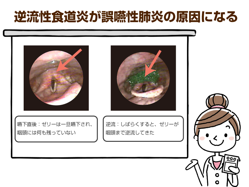 逆流性食道炎が誤嚥性肺炎の原因になる