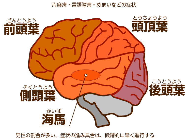 血管性認知症になる脳の図解