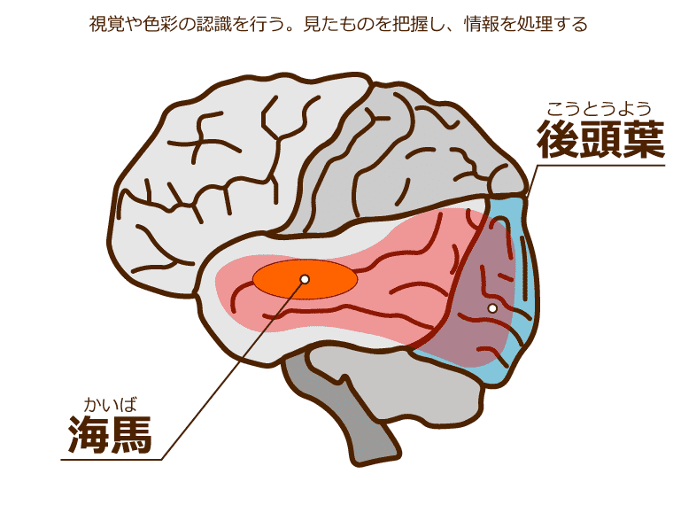 レビー小体型認知症になる脳の図解