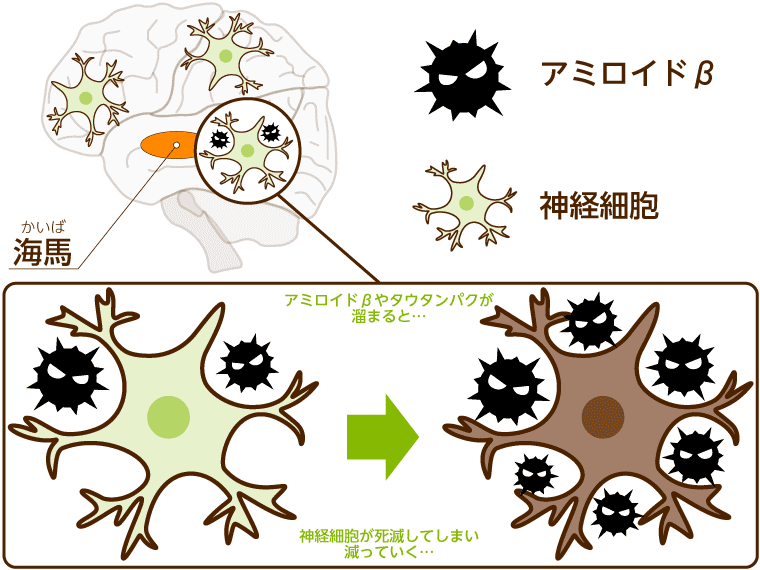 アルツハイマー病の原因