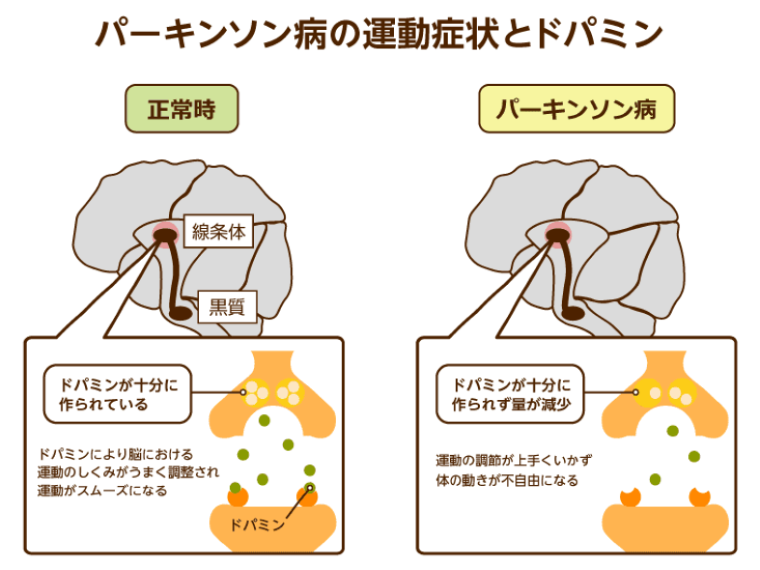 わかりやすく解説】パーキンソン病とは？症状や治療法・原因｜みんなの介護